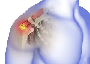 Rotator Cuff Tear
