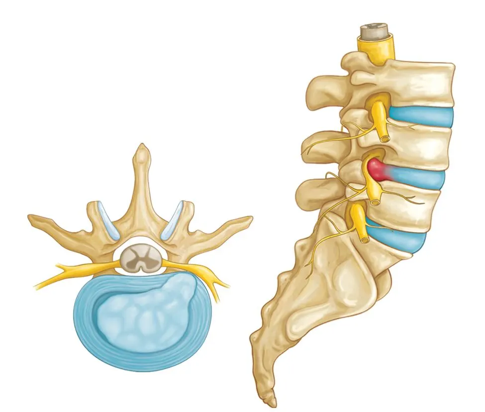 Prolapsed Intervertebral Disc