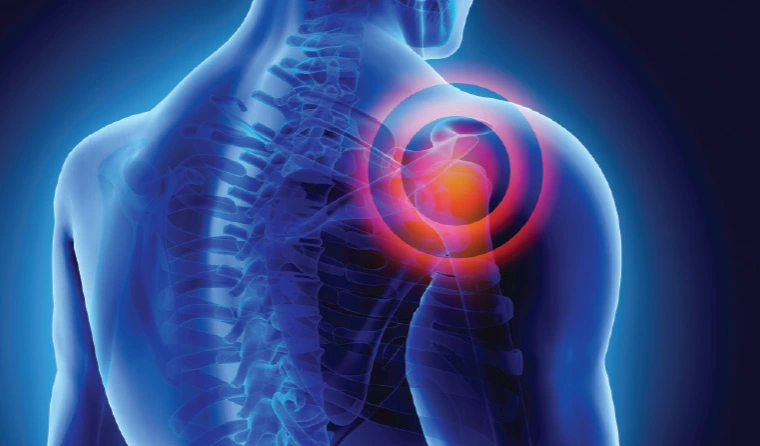 Shoulder Stiffness