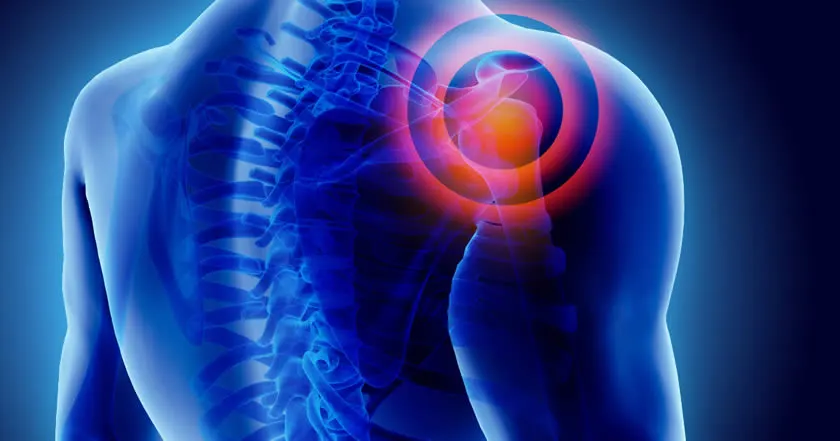 Shoulder Arthritis