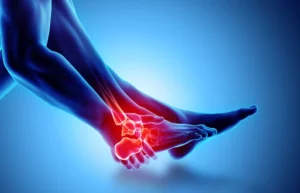 Common Peroneal Nerve Injury