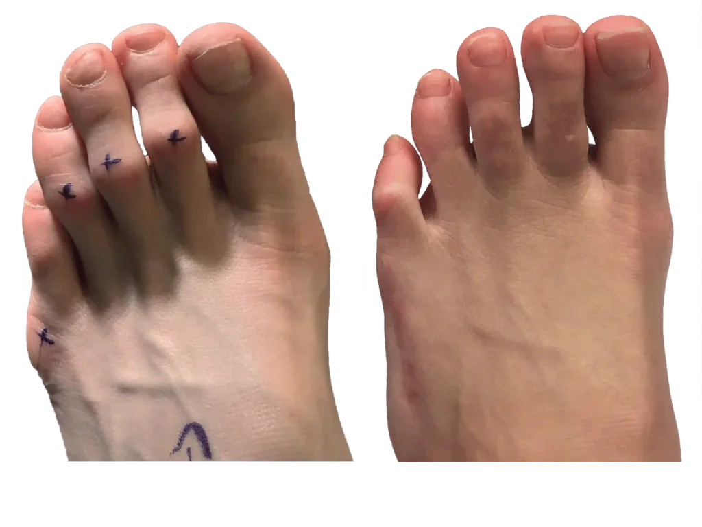 Hammer Toe