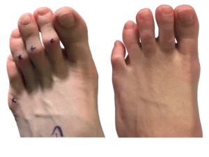 Hammer Toe