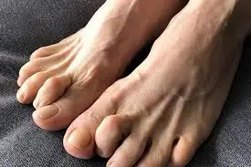 Claw Toe