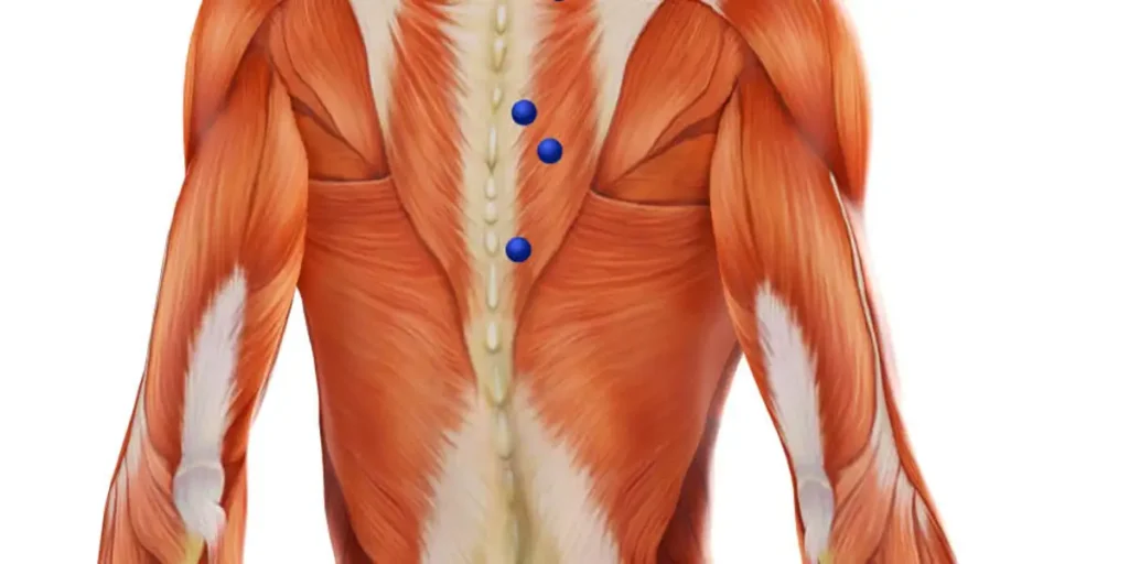 Myofascial Pain