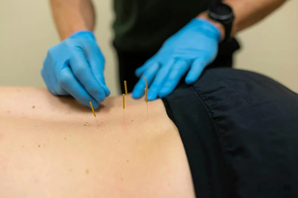 Dry Needling
