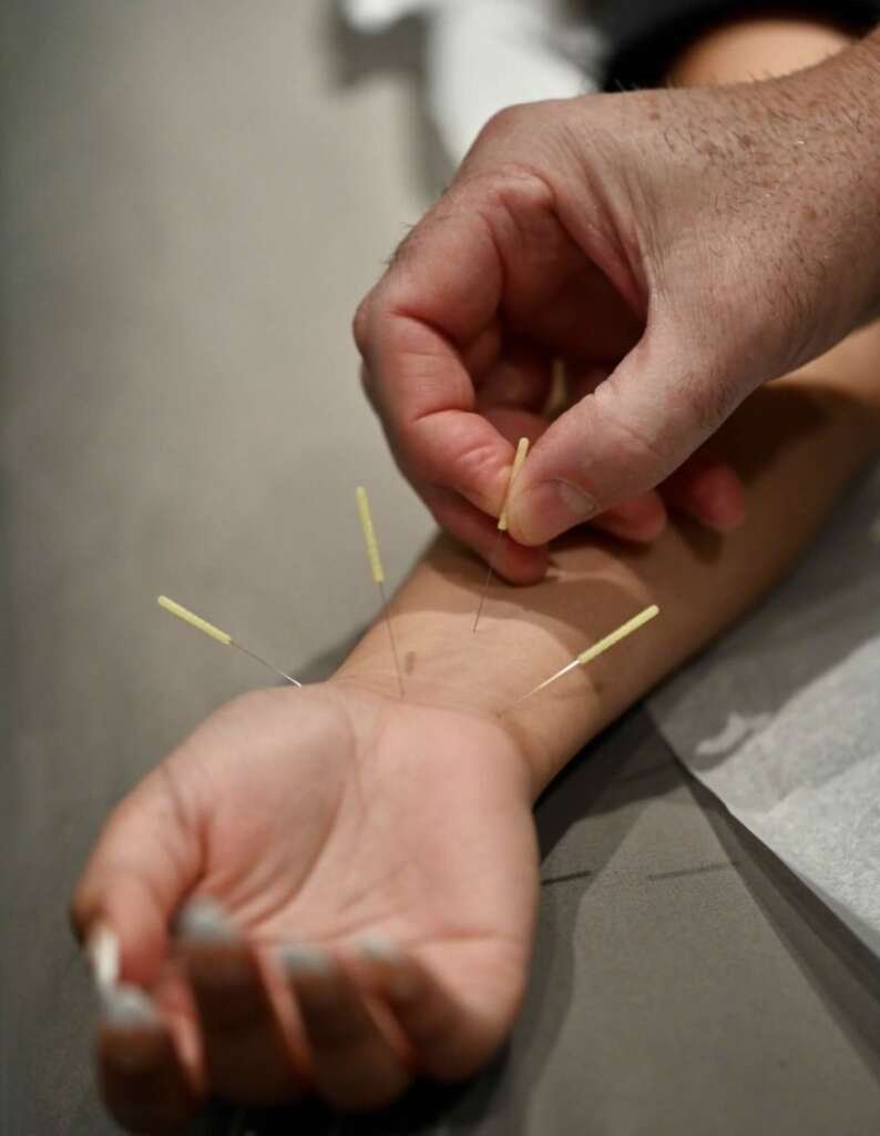 Dry Needling
