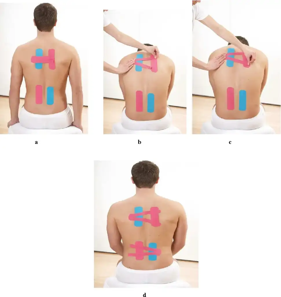 Kinesio Taping Therapy