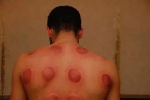 Cupping Therapy