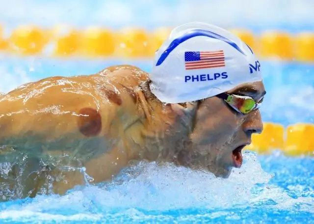 Cupping Therapy