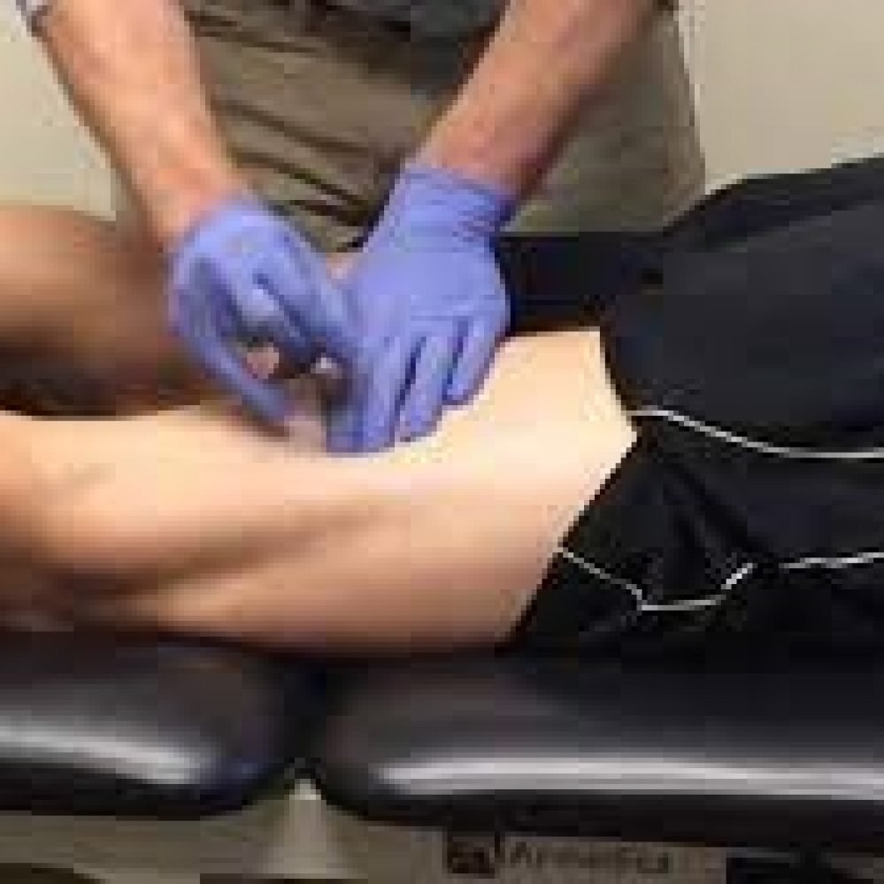 Dry Needling